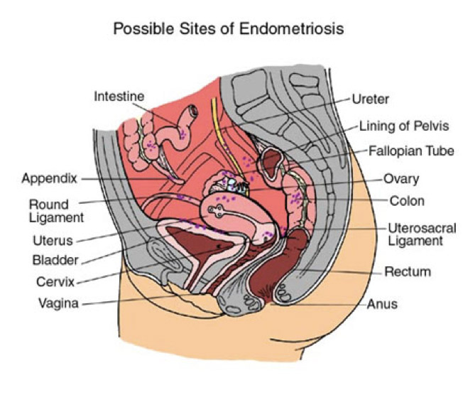 Endometriosis image