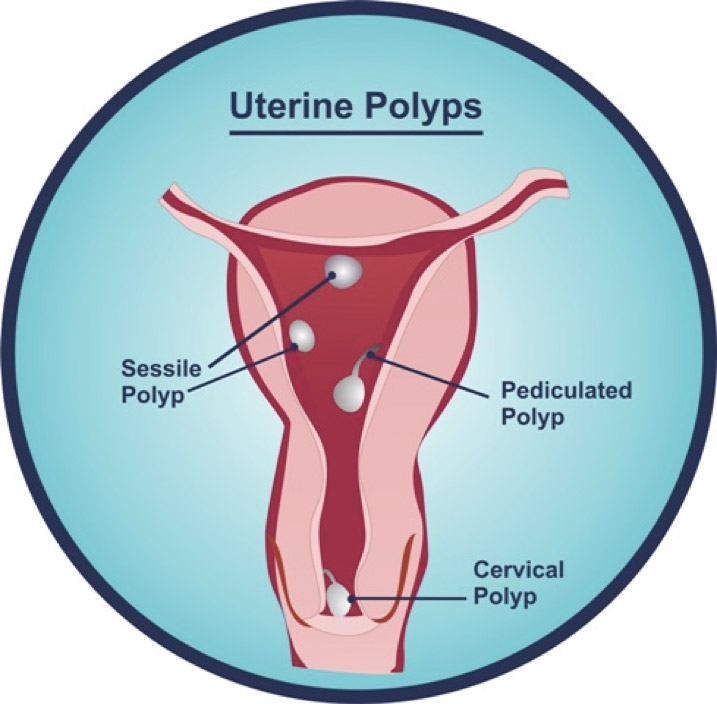 uterine polyps